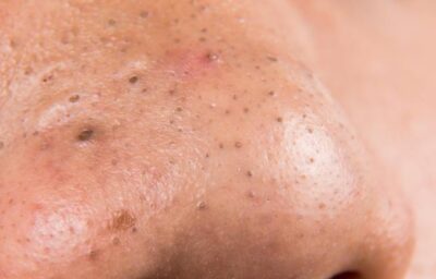 नाक में होने वाली काली कीलो से है परेशान तो अपनाए कुछ घरेलु उपचार