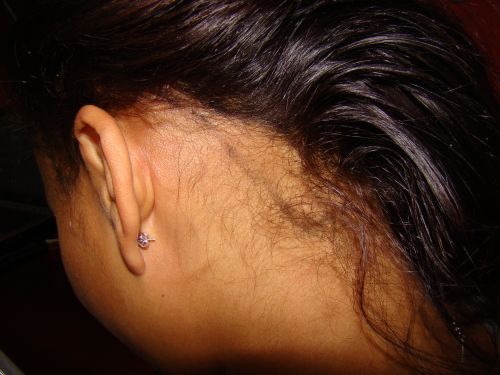 18-afro-american-hair-loss-before