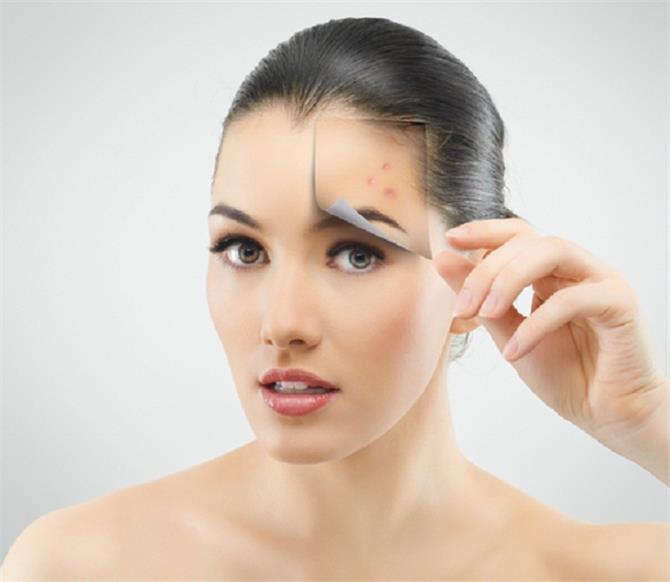2015_10image_10_57_283641063treating-acne-ll