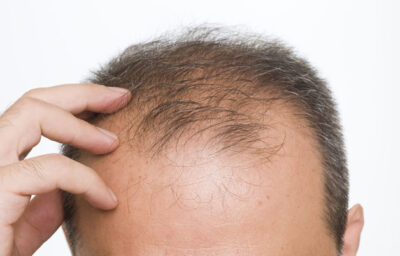 झड़ते बालो को रोकने के लिए करे ये 7 घरेलु उपचार