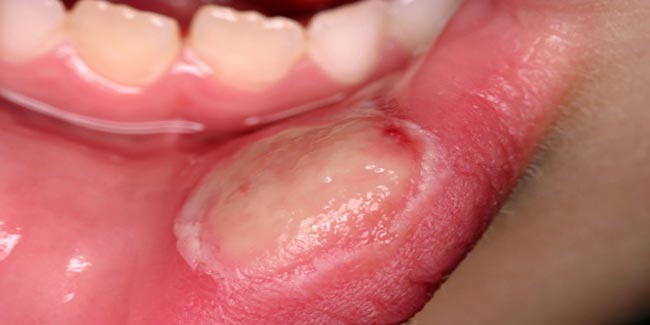 home-remedies-650x325